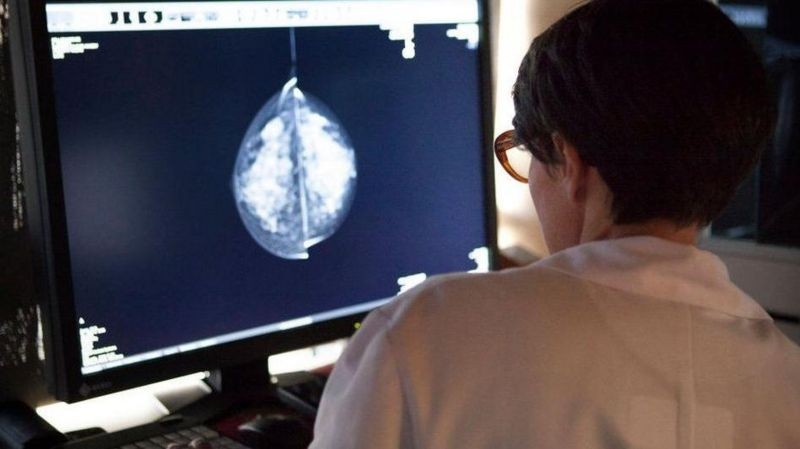 الذكاء الاصطناعي يحمل وعودا كبيرة في فحص سرطان الثدي